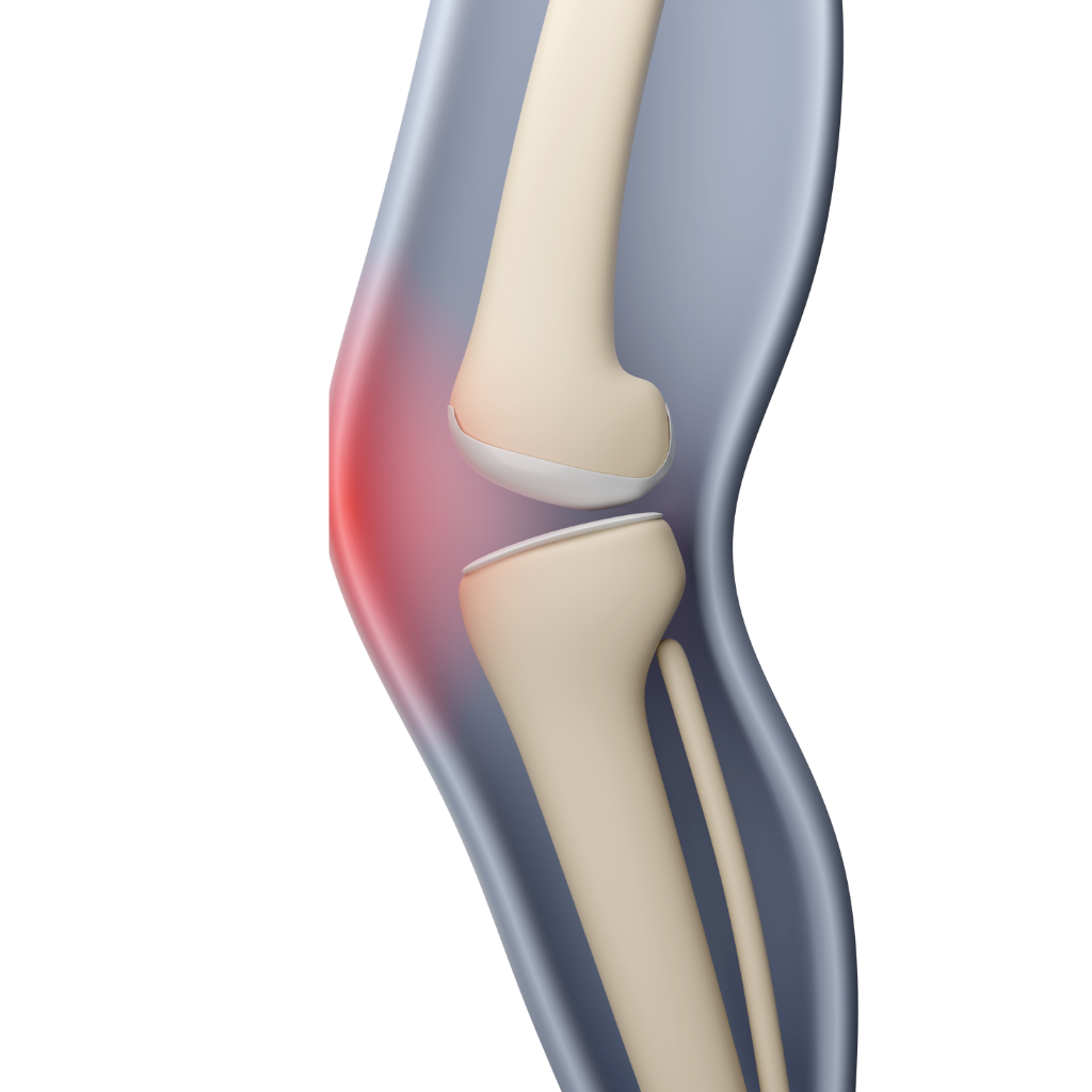 Cartilage deterioration